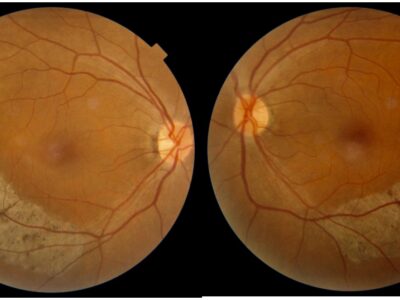 Bilateral sector retinitis pigmentosa001