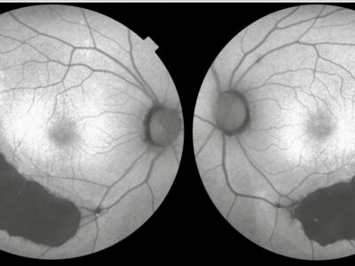 Bilateral sector retinitis pigmentosa002