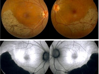 Bilateral sector retinitis pigmentosa003