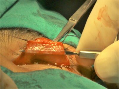 Conjunctival-Sparing Posterior Ptosis Surgery